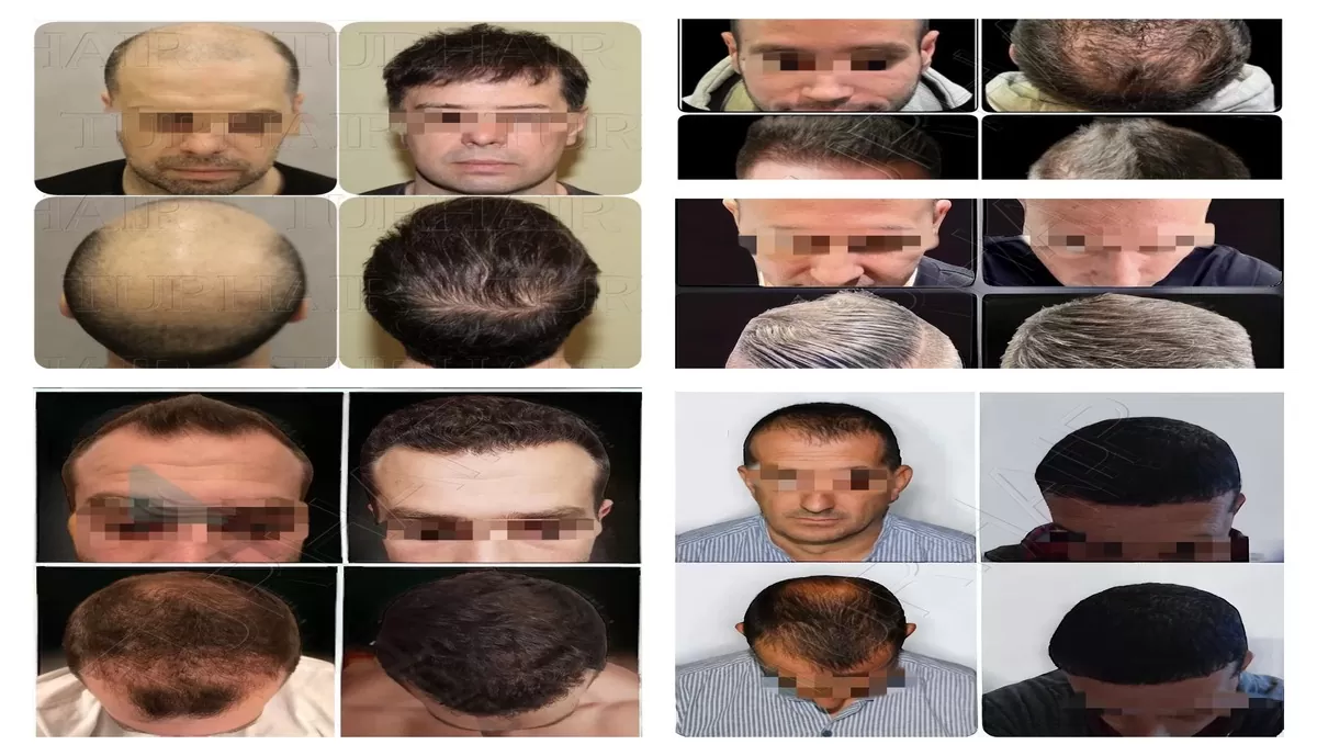 Най-доброто решение за косопад в Турция VIP подходът на Turhair